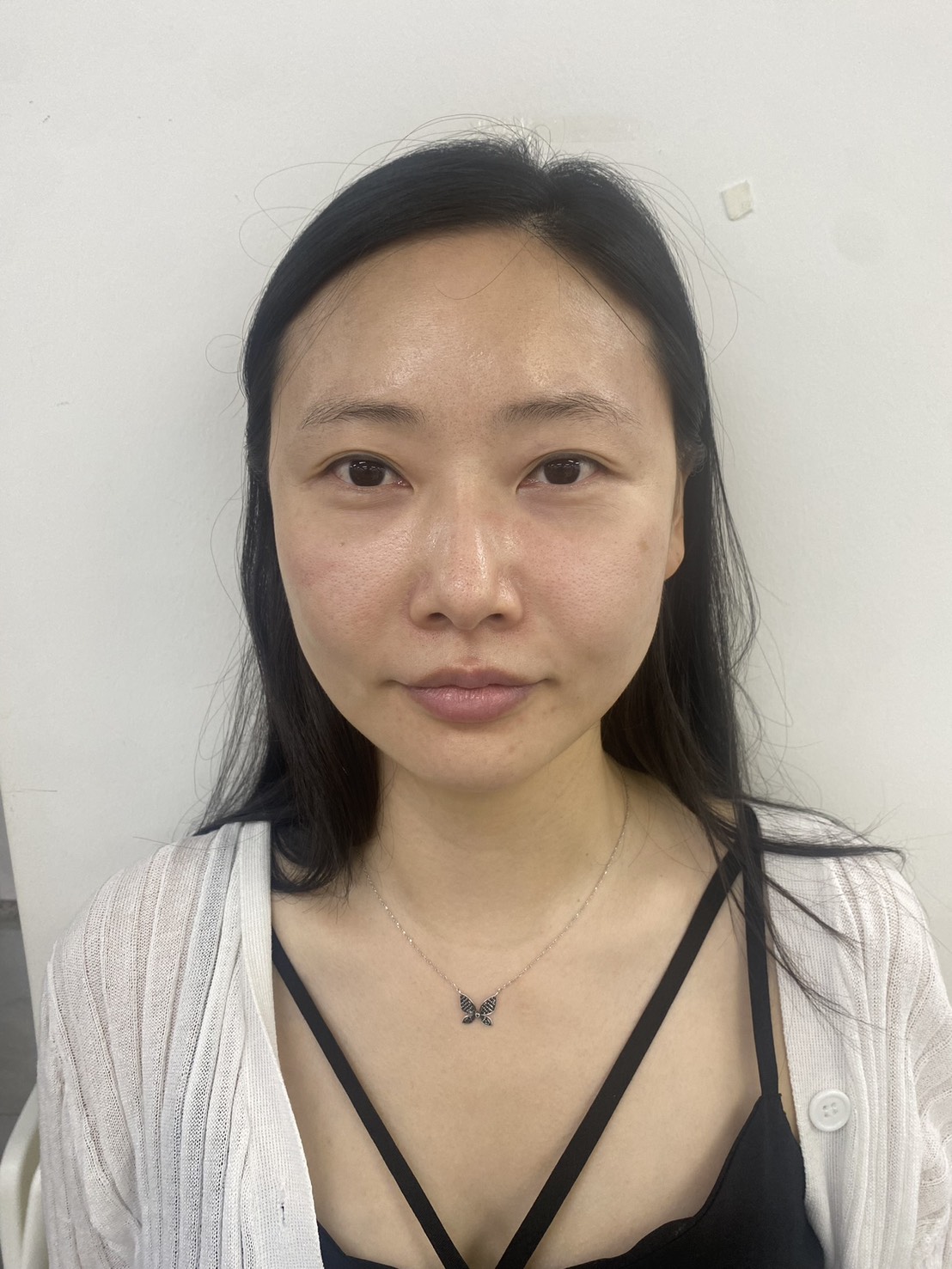 インセルダム使用前の肌の状態（みな先生）